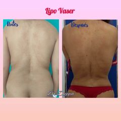 Lipo vaser