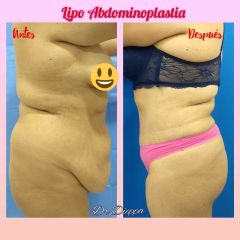 Lipo abdominoplastia