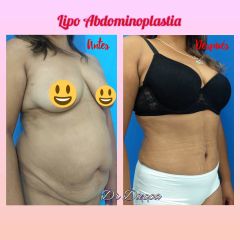 Lipo abdominoplastia