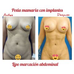 Lipo marcación abdominal con implantes mamarios