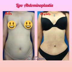 Abdominoplastia