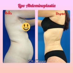 Abdominoplastia