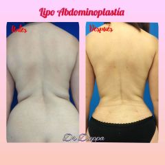 Abdominoplastia