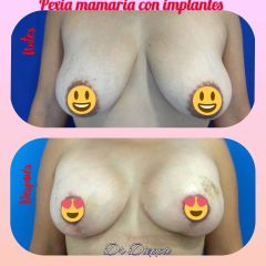 Mastopexia