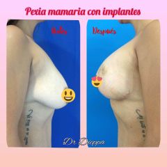 Mastopexia