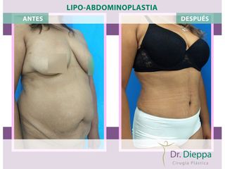 Lipoabdomindoplastia - Cirugía Plástica Dieppa
