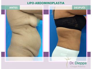 Lipoabdomindoplastia - Cirugía Plástica Dieppa
