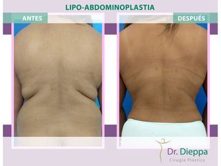 Lipoabdomindoplastia - Cirugía Plástica Dieppa