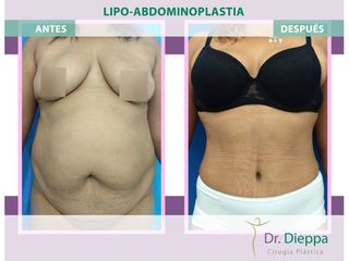 Lipoabdomindoplastia - Cirugía Plástica Dieppa