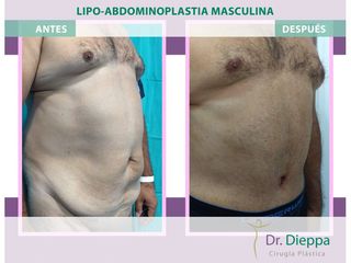 Lipoabdomindoplastia - Cirugía Plástica Dieppa