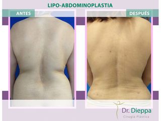Lipoabdomindoplastia - Cirugía Plástica Dieppa