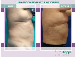 Lipoabdomindoplastia - Cirugía Plástica Dieppa