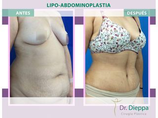 Lipoabdomindoplastia - Cirugía Plástica Dieppa