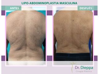 Lipoabdomindoplastia - Cirugía Plástica Dieppa