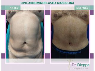 Lipoabdomindoplastia - Cirugía Plástica Dieppa