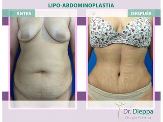 Lipoabdomindoplastia - Cirugía Plástica Dieppa