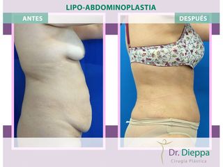 Lipoabdomindoplastia - Cirugía Plástica Dieppa