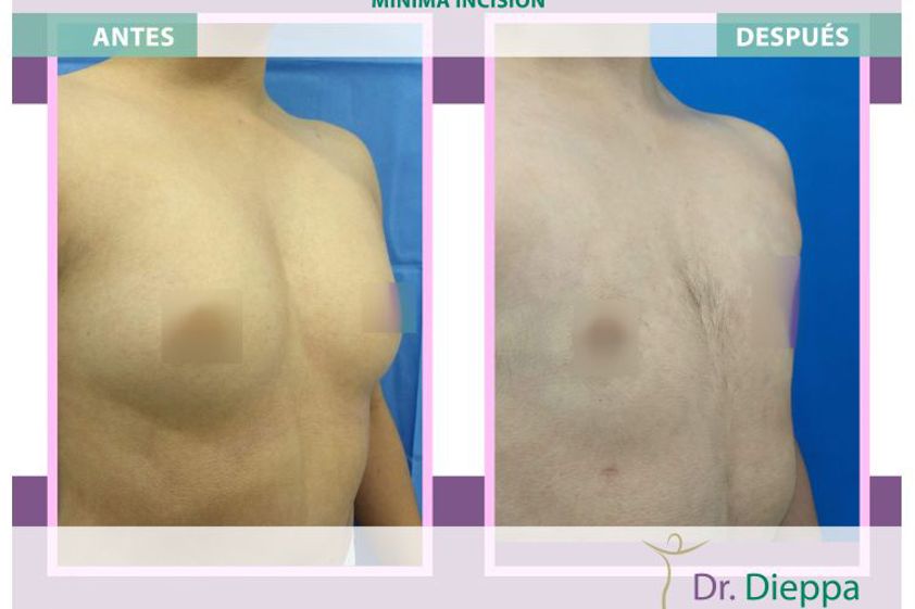 Reasignación de sexo antes y después - 663852