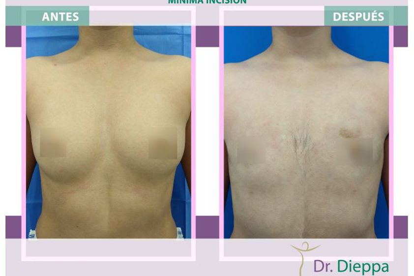 Reasignación de sexo antes y después - 663853