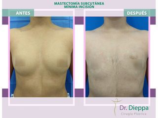Mastectomía subcutánea - Cirugía Plástica Dieppa
