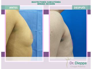Mastectomía subcutánea - Cirugía Plástica Dieppa