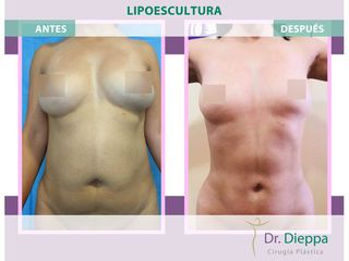 Lipoescultura - Cirugía Plástica Dieppa