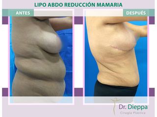 Lipoabdomindoplastia + Reducción mamaria - Cirugía Plástica Dieppa