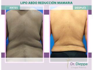 Lipoabdomindoplastia + Reducción mamaria - Cirugía Plástica Dieppa