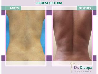 Lipoescultura - Cirugía Plástica Dieppa