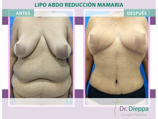 Lipoabdomindoplastia + Reducción mamaria - Cirugía Plástica Dieppa