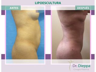 Lipoescultura - Cirugía Plástica Dieppa