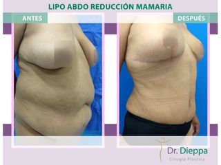 Lipoabdomindoplastia + Reducción mamaria - Cirugía Plástica Dieppa