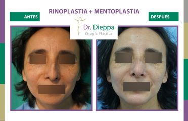 Rinoplastia + mentoplastia - Cirugía Plástica Dieppa