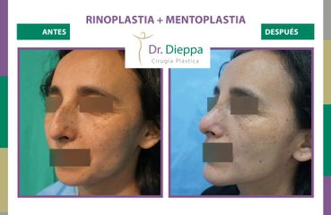 Rinoplastia + mentoplastia - Cirugía Plástica Dieppa