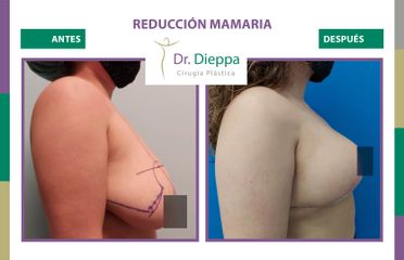Reducción mamaria - Cirugía Plástica Dieppa