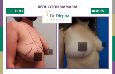 Reducción mamaria - Cirugía Plástica Dieppa