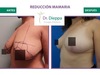 Reducción mamaria-776510