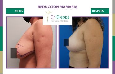 Reducción mamaria - Cirugía Plástica Dieppa