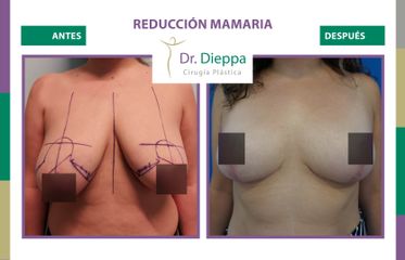 Reducción mamaria - Cirugía Plástica Dieppa
