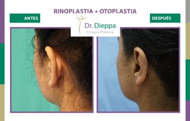 Rinoplastia + Otoplastia - Cirugía Plástica Dieppa
