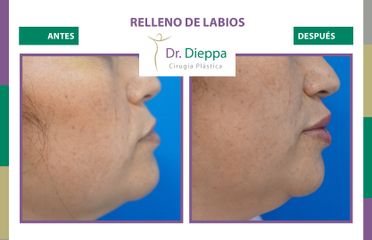 Aumento de labios - Cirugía Plástica Dieppa