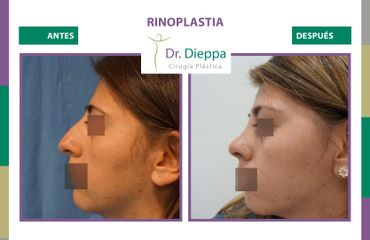 Rinoplastia - Dr Dieppa