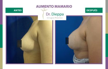 Aumento Mamario - Dr Dieppa