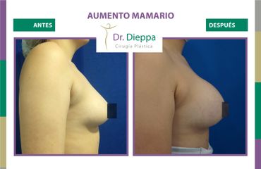 Aumento Mamario - Dr Dieppa