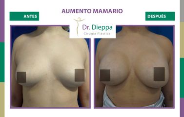 Aumento Mamario - Dr Dieppa