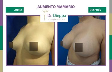 Aumento Mamario - Dr Dieppa