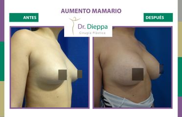 Aumento Mamario - Dr Dieppa