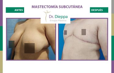 Mastectomía subcutánea - Cirugía Plástica Dieppa