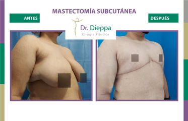 Mastectomía subcutánea - Dr Dieppa