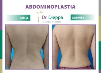 Abdominoplastia  - Cirugía Plástica Dieppa
